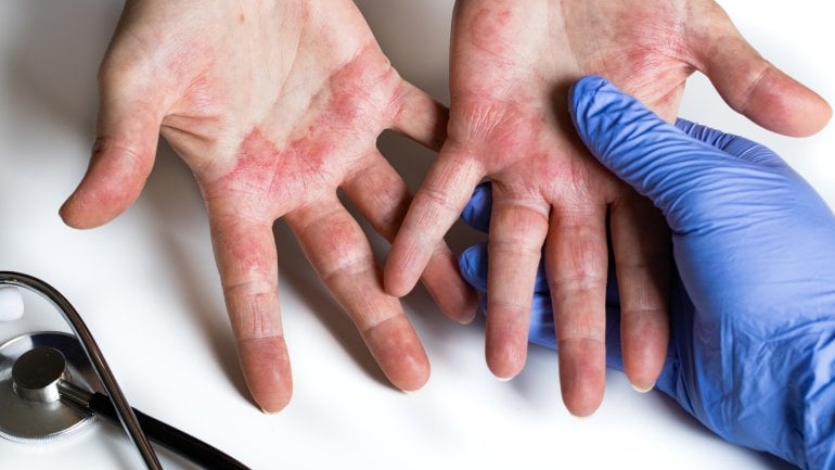 Neurodermitis-Bilder: Atopisches Ekzem an der Hand oder am Fuß