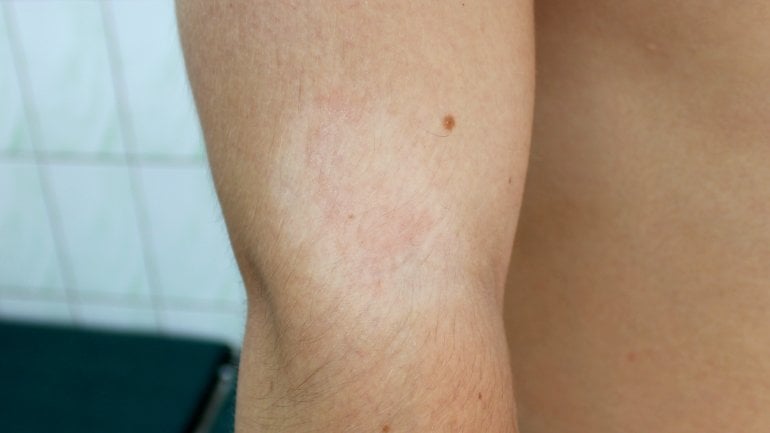 Weiße Flecken bei Neurodermitis: Pityriasis alba