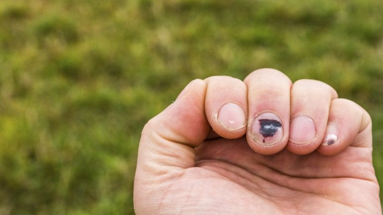 Das Bild zeigt eine Quetschung am Mittelfinger.