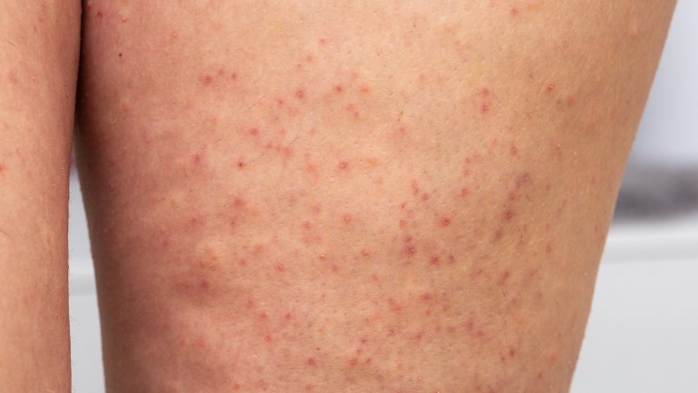 Nahaufnahme eines Oberschenkels mit Keratosis pilaris