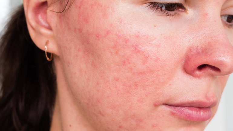 Eine Frau mit Rosacea