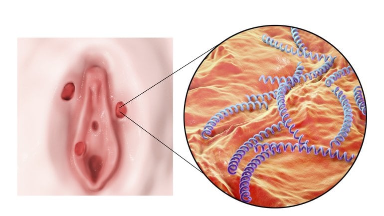 Primäre Syphilis: Rotes Geschwür ist ein erstes Symptom